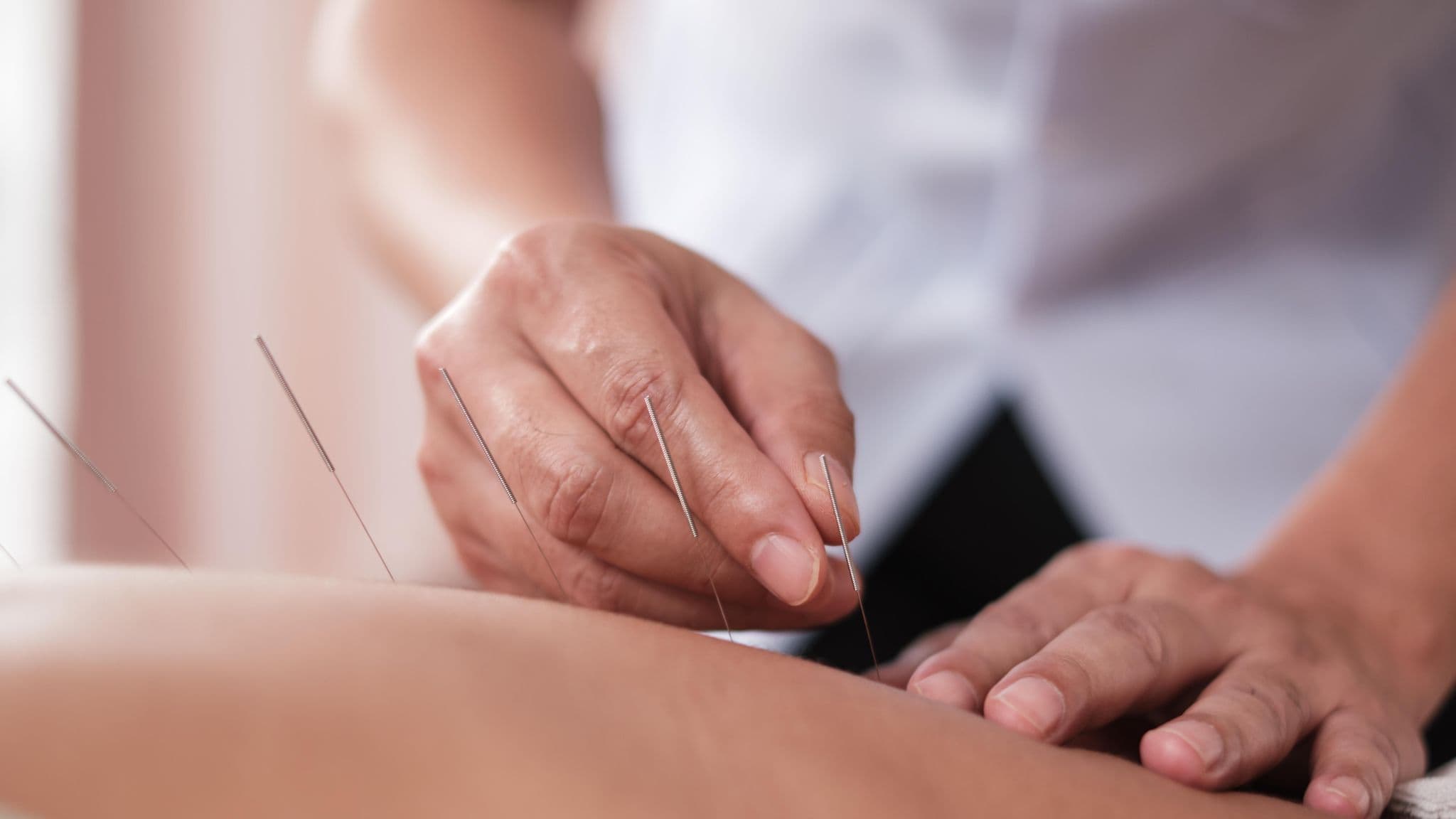 How Acupuncture Supports Long Term Pain Management