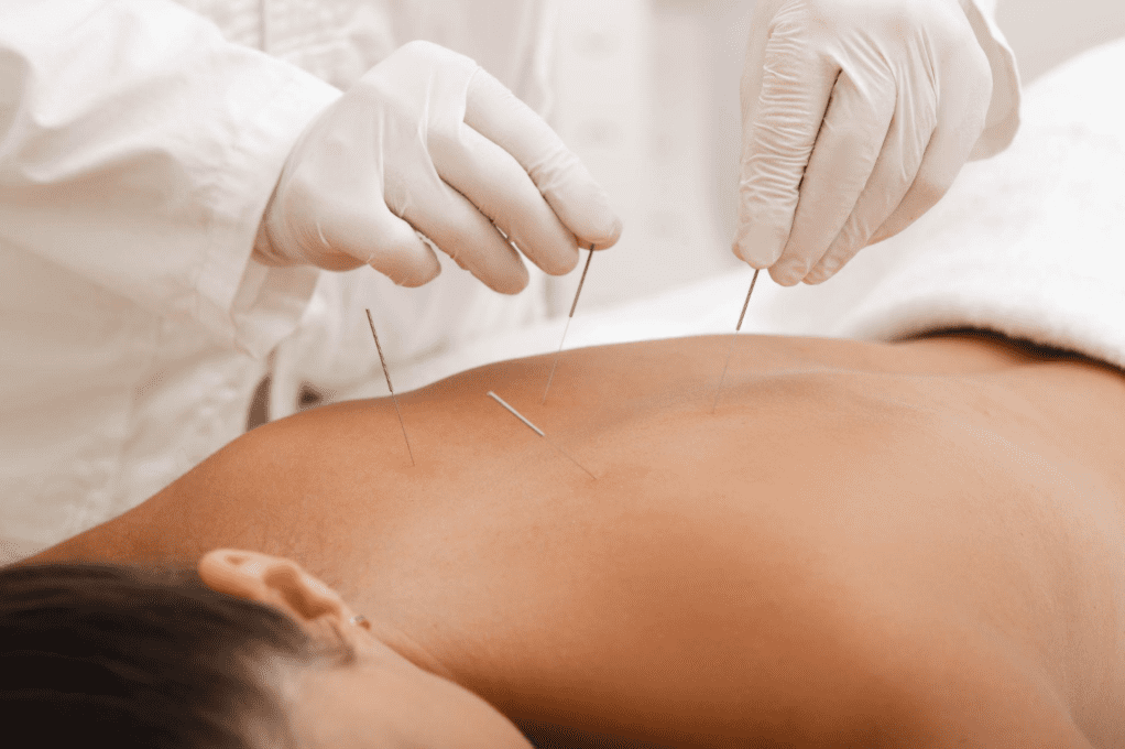 Acupuncture for Back and Neck Pain: Benefits, Results & What to Expect