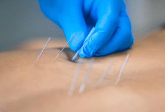 How to Store and Handle Acupuncture Needles Safely