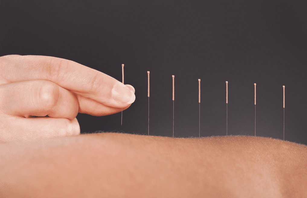 Choosing the Right Acupuncture Needles: Size, Gauge and Safety Considerations