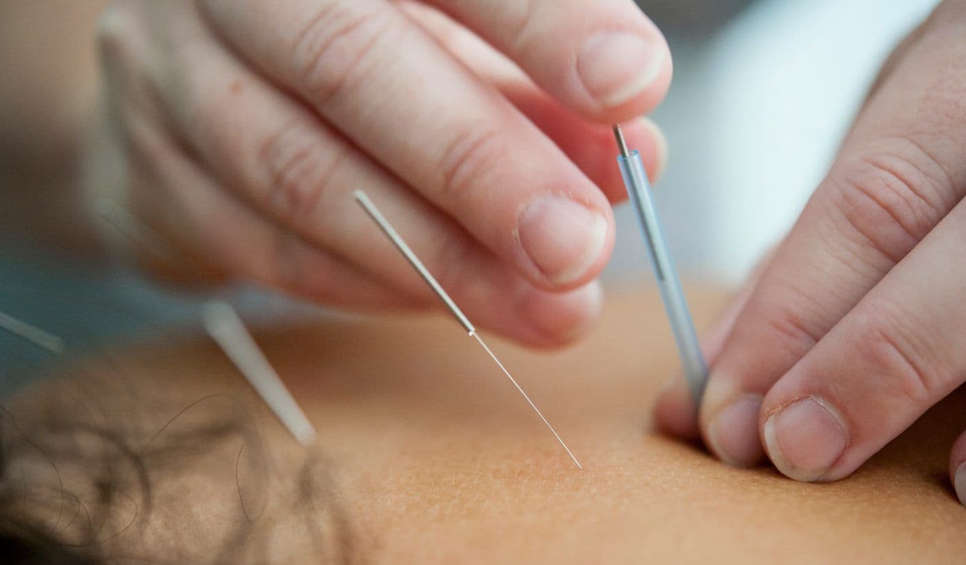 A Practitioner’s Guide to Safe Acupuncture Needle Handling, Storage & Disposal