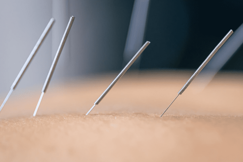 Acupuncture Needle Quality: Why It Matters More Than You Think
