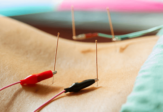 Electro Therapy Acupuncture vs Traditional Acupuncture: Benefits, Differences & Applications