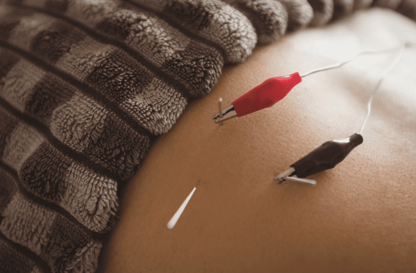 How Electro Therapy Acupuncture Stimulates Healing and Recovery