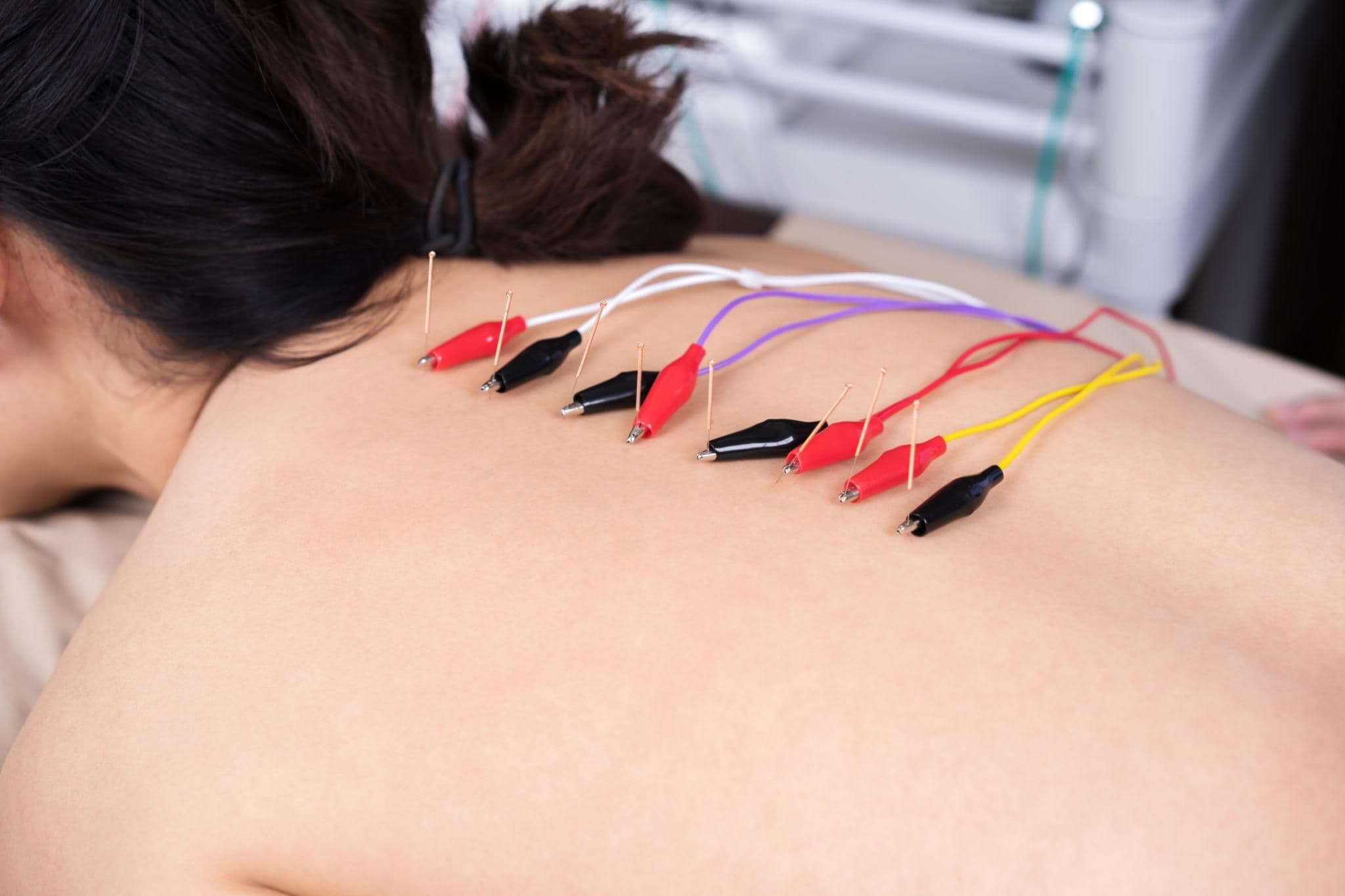 Electro-Acupuncture for Nerve Stimulation and Functional Recovery