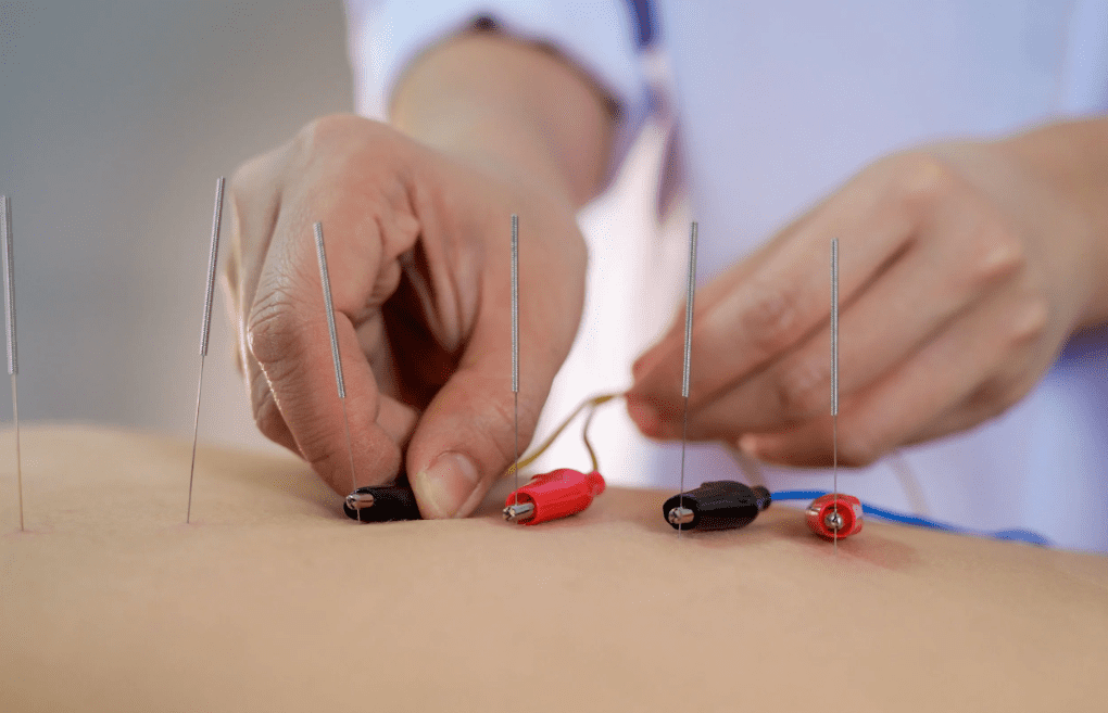 Why Electro Acupuncture Is Effective for Muscle Recovery