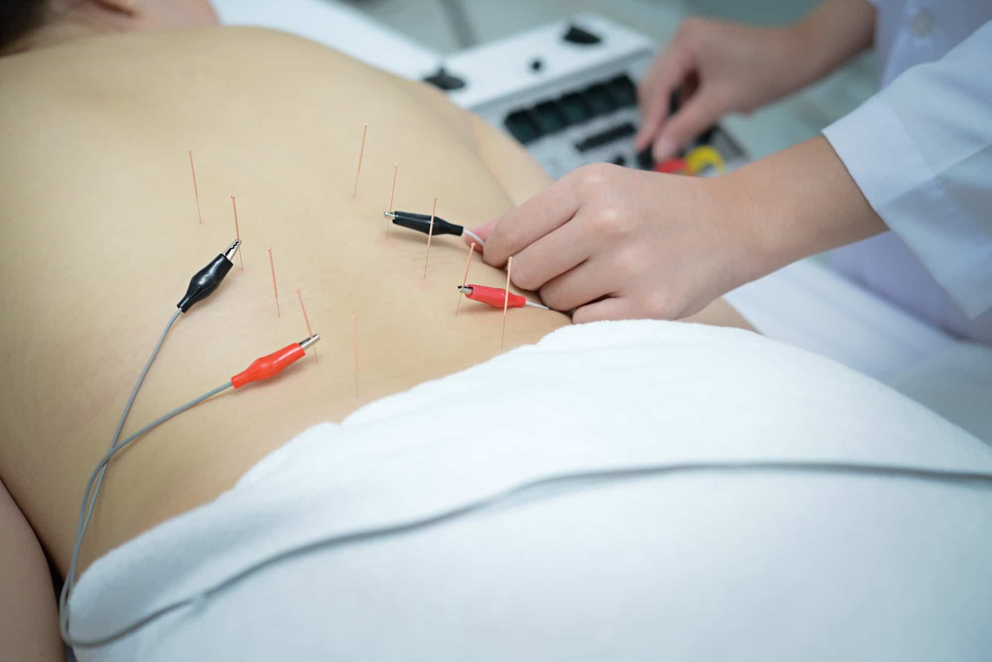 Integrating Electro Therapy and Acupuncture: Boosting Clinic Outcomes