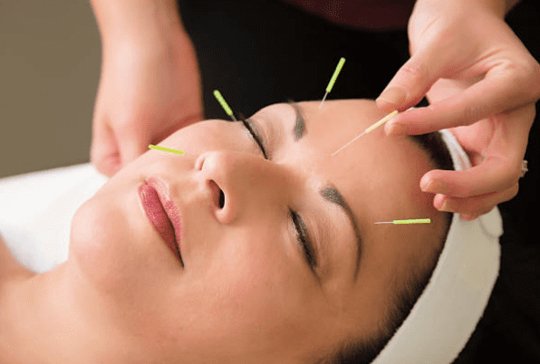 Facial Acupuncture Benefits: How It Revitalises Skin and Reduces Wrinkles