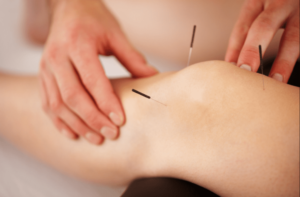 How Acupuncture Supports Recovery from Sports Injuries