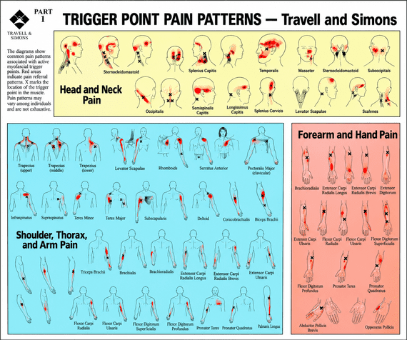 Trigger Points Pain Patterns chart