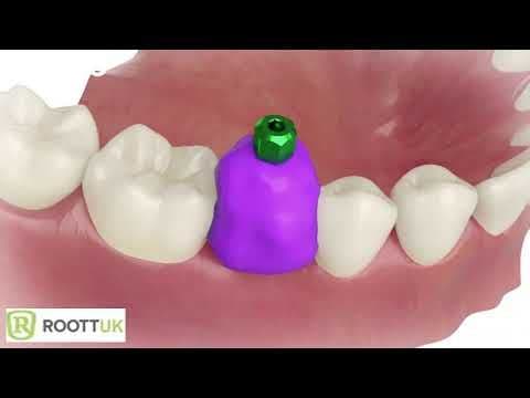 ROOT R 3 8mm Two Piece incl Implant Abutment scanpost transfer & cover ...