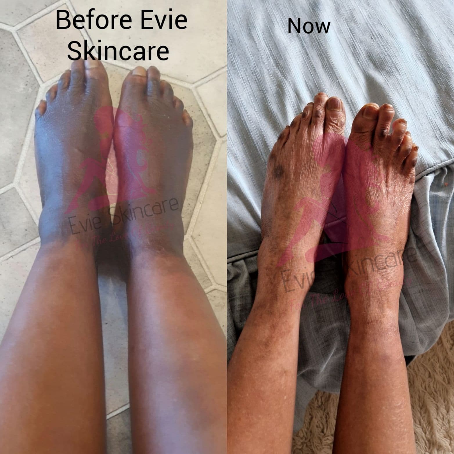 Dark Feet before and after