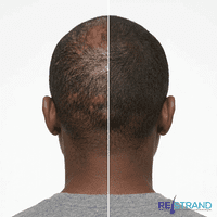 Hair Loss Concealer | Hair Building Fibres | RESTRAND
