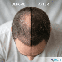 Hair Loss Concealer | Hair Building Fibres | RESTRAND