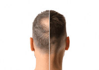 Hair Loss Concealer | Hair Building Fibres | RESTRAND