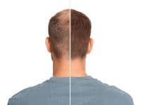 Hair Loss Concealer | Hair Building Fibres | RESTRAND