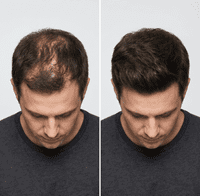 Hair Thickening Spray | Instant Hair Thickener | Hair Loss Concealer | RESTRAND