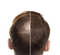 Hair Thickening Spray | Instant Hair Thickener | Hair Loss Concealer | RESTRAND