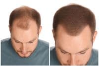 Hair Thickening Spray | Instant Hair Thickener | Hair Loss Concealer | RESTRAND