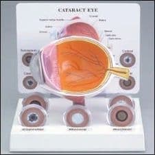 Modelo Cataratas Ojo Con Lentes Intercambiables Modelo Anatómico