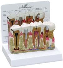 Modelo Dientes Y Encías Enfermos Tamaño: 5-1 / 2 X 6 X 6
