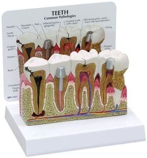 Modelo Dientes Y Encías Enfermos Tamaño: 5-1 / 2 X 6 X 6