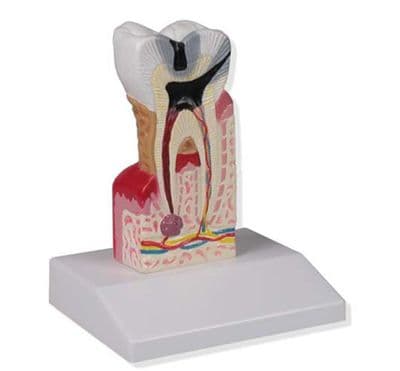 10 x Dental Caries Model
