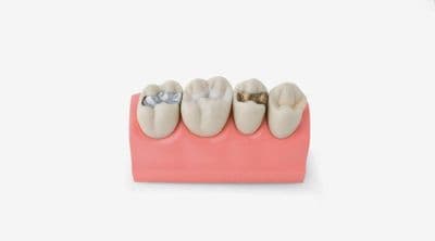 Caries/Restoration Model