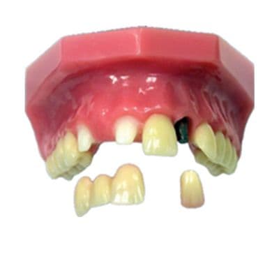 Congenitally Missing Lateral Incisor Model