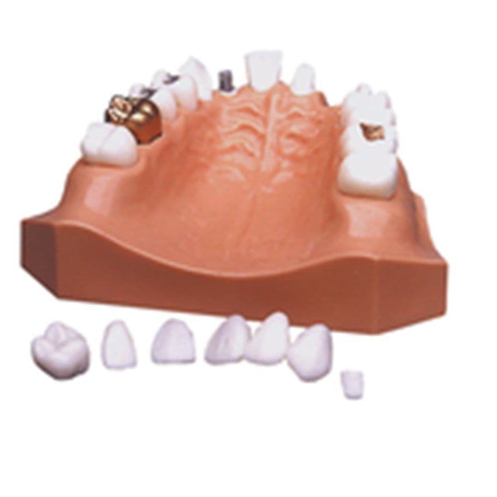 Crown and Bridge Model