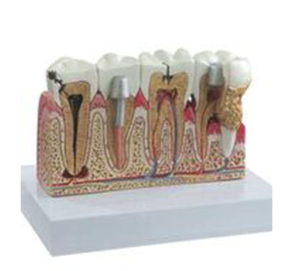 Diseased Tooth Model
