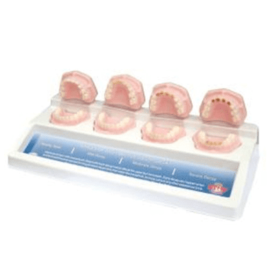 Progression of Baby Bottle Tooth Decay Model
