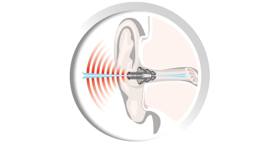 Auritech Shooting Ear Plugs Hearing Protection Clay Pigeon Game Hunting