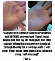 Thyme Out The Knockout Alternative For Eczema 8oz + 1/4oz To Go Bottle