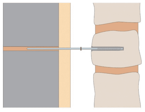 Ancon Staifix Cavity Starter Tie