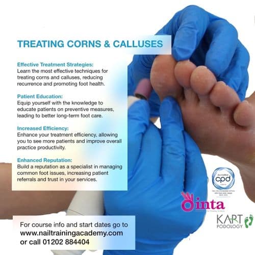 Treating Corns and Calluses