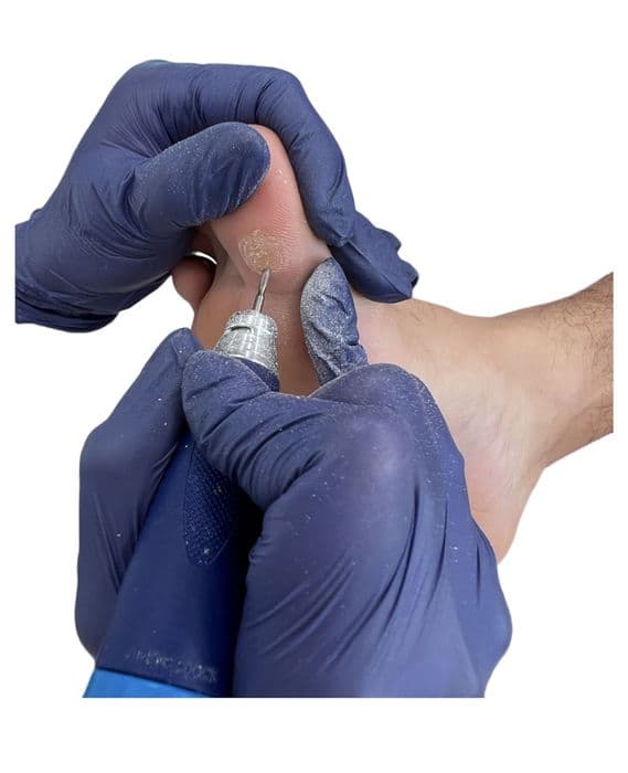 01842-23 Corns And Calluses , 2025 ICD-10-CM Diagnosis Code L84: Corns ...