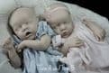 Twin A