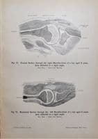 SHOULDER JOINT ANTERIOR VIEW  Original Antique Anatomy Lithographed Print 1906