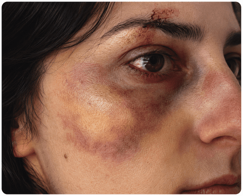 How to Create Realistic SFX Bruise Makeup with Aquagel