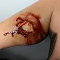 Bite Prosthetic | Kast FX