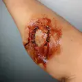 Bite Prosthetic | Kast FX